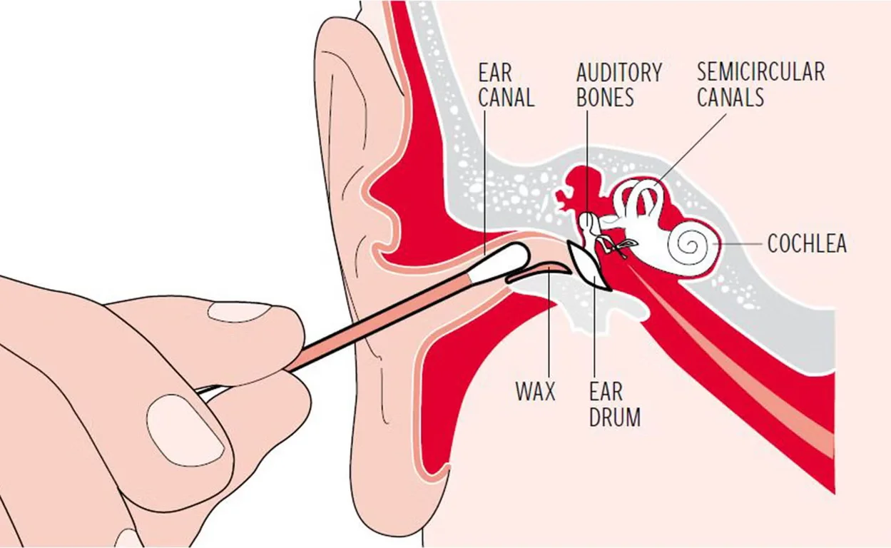 Don't use cotton buds for ear cleaning