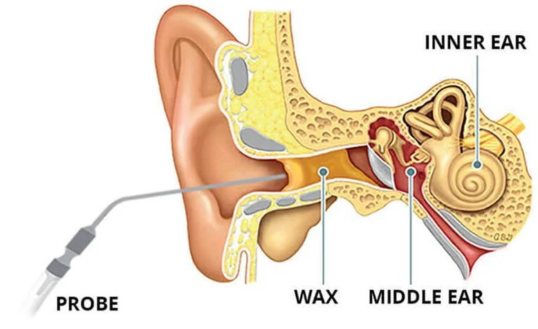 Microsuction Earwax removal