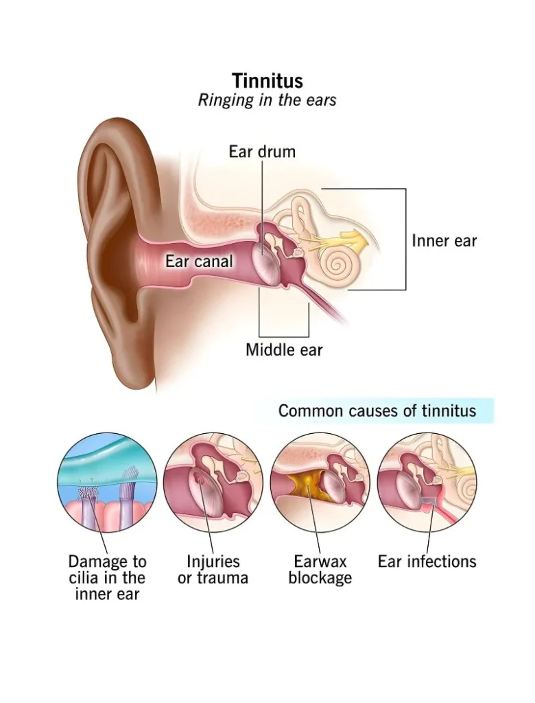 Tinnitus